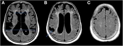 Spectral Domain-Optical Coherence Tomography As a New Diagnostic Marker for Idiopathic Normal Pressure Hydrocephalus